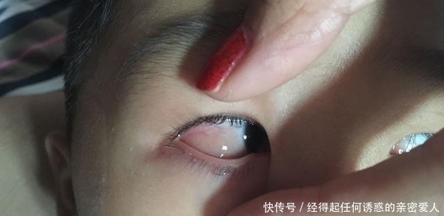 家长|5岁孩子眼睛疼，奶奶和妈妈都没在意，几天后检查医生：来晚了