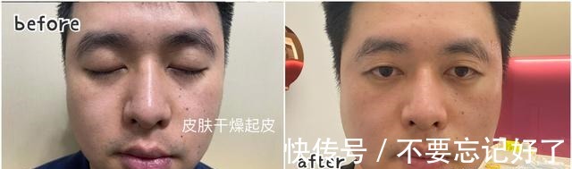 弊端 用过都说好的光子嫩肤也有弊端!