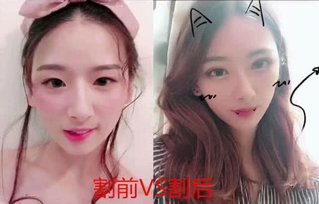 双眼皮|割双眼皮前VS割双眼皮后,看见差距,眼睛变好看了但灵魂没了