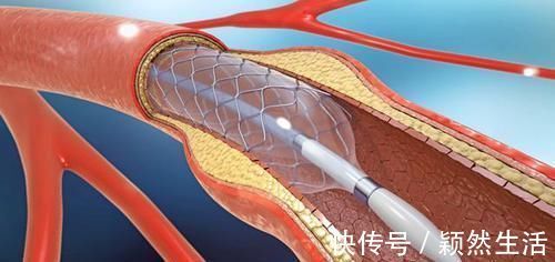 体检|体检查出颈动脉斑块必须吃药?医生:比起吃药,还有件事同样重要