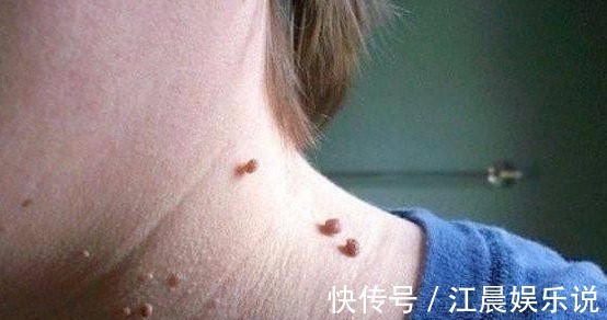 瘙痒|农村有种常见的野草,是治疗瘊子的良药,分分钟治好不再长