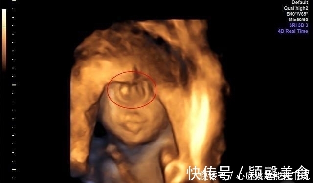 双胞胎|产妇孕期产检，看B超以为是双胞胎，孩子出生后全家却乱作一团