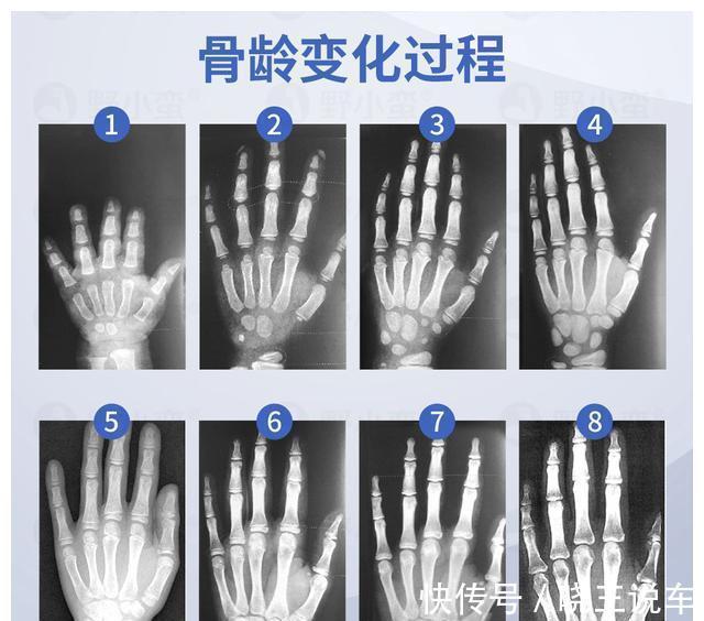 营养素|身高管理2.0时代启幕!“控骨龄+促生长”双管齐下助长高