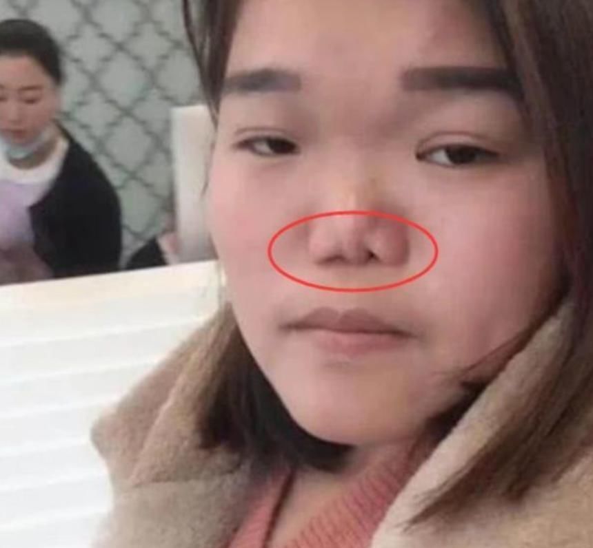 黑头粉刺|最“毁鼻子”的3行为,学生党却养成习惯,占一个异性缘归0哟!