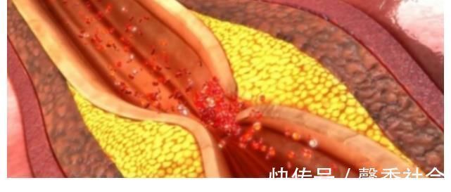 心血管医生|多走路可以降血脂？心血管医生：过了50岁，做好3件事更有效果