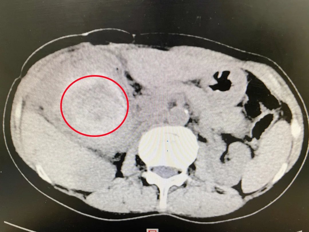 蛔虫|重234克直径12厘米！世界上最大的单颗胆总管结石成功摘除