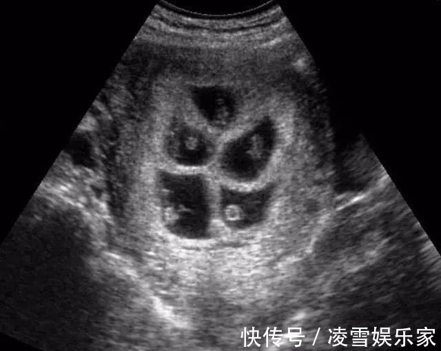 双胞胎|孕妈喜获6胞胎，看到孩子的性别，医生感叹这才是真正的金六福