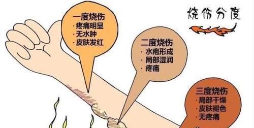 医生|男婴被100度开水烫伤后,妈妈做法遭全家反对,却得到医生点赞