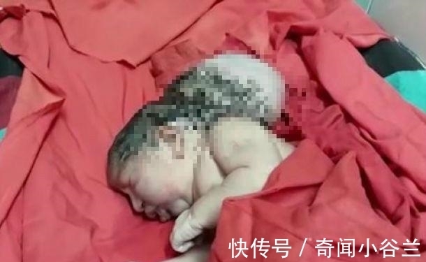 脑肿胀|外国妇女生下三个女孩!没有感觉的时候怀孕了,产科医生:像外星