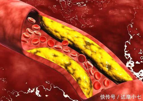 高血脂|63岁老人高血脂20年,仅用2个方法,各项指标慢慢恢复正常