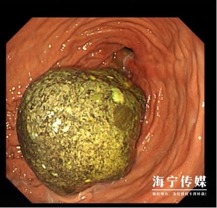 医生|男子爱吃一种水果，体内长出“金色巨石”！医生20多次没取完