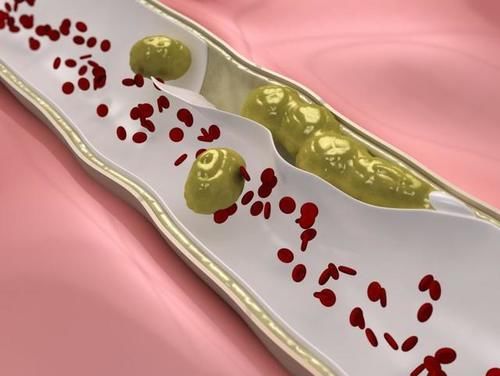 升高|血脂偏高的人，会有哪些表现？