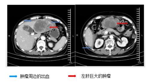 肿瘤|命悬一线！阿婆肚子剧烈疼痛竟是巨大肝癌破裂出血，还和十五年前患过肝炎有关