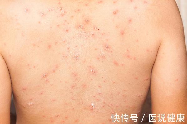 发作|荨麻疹进入晚上后,症状会加重,或与这6个因素有关,需重视