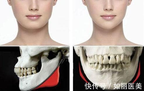 切除 下颌角削骨后有哪些后遗症?术后需要注意事项有哪些
