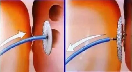 导管|知多点:长期不明原因头晕头疼?有可能是卵圆孔未闭