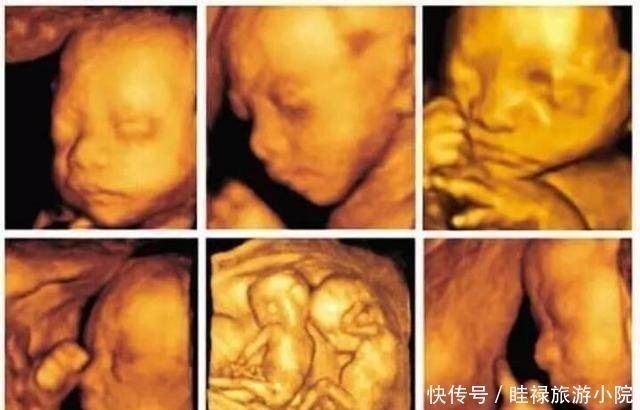 医生|孕期产检不想生个“傻孩子”,这三项产检必须按时做,不能忽视