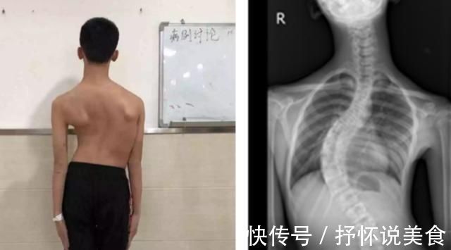 受压|8岁男孩脊椎侧弯,只因家人常做这个动作,这个错误,90%的父母都在犯