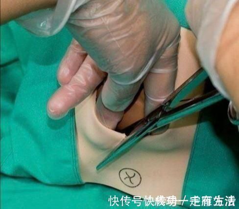 缝针|孕妇须知:顺产侧切后,缝针会不会很疼?答案跟你想的不一样