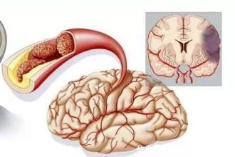 血脂升|心内科医生:血脂高不高看脸就知道,血脂高的人,脸上有3个特征