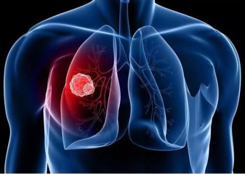 夫妻俩|夫妻俩查出肺癌，丈夫离世，妻子重症室，医生摇头：这种病，怎么敢一拖再拖