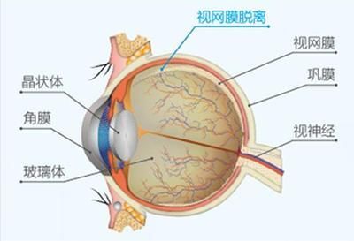  视网膜脱落的3个前兆！别拖延，及时发现及时治疗