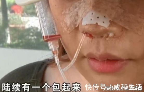 假体|女子高价整容，脸上挂满“注射器”，医院：赔你点吧