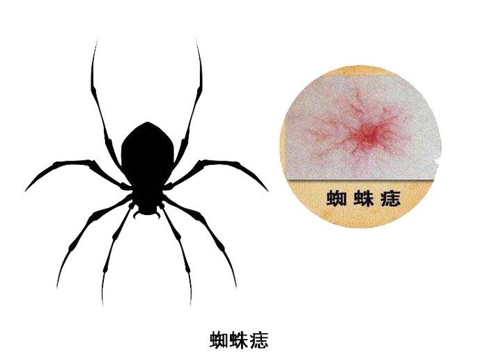 血循环|脂肪肝若找上门来,4个异常在所难免,若你没有,值得庆贺!