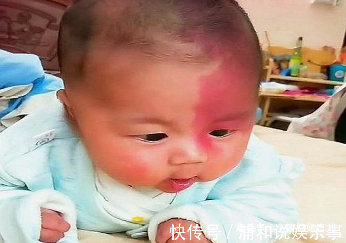 产科医生|胎记是怎么来的?妇科医生:除了遗传,孕期尽量避开这3种行为