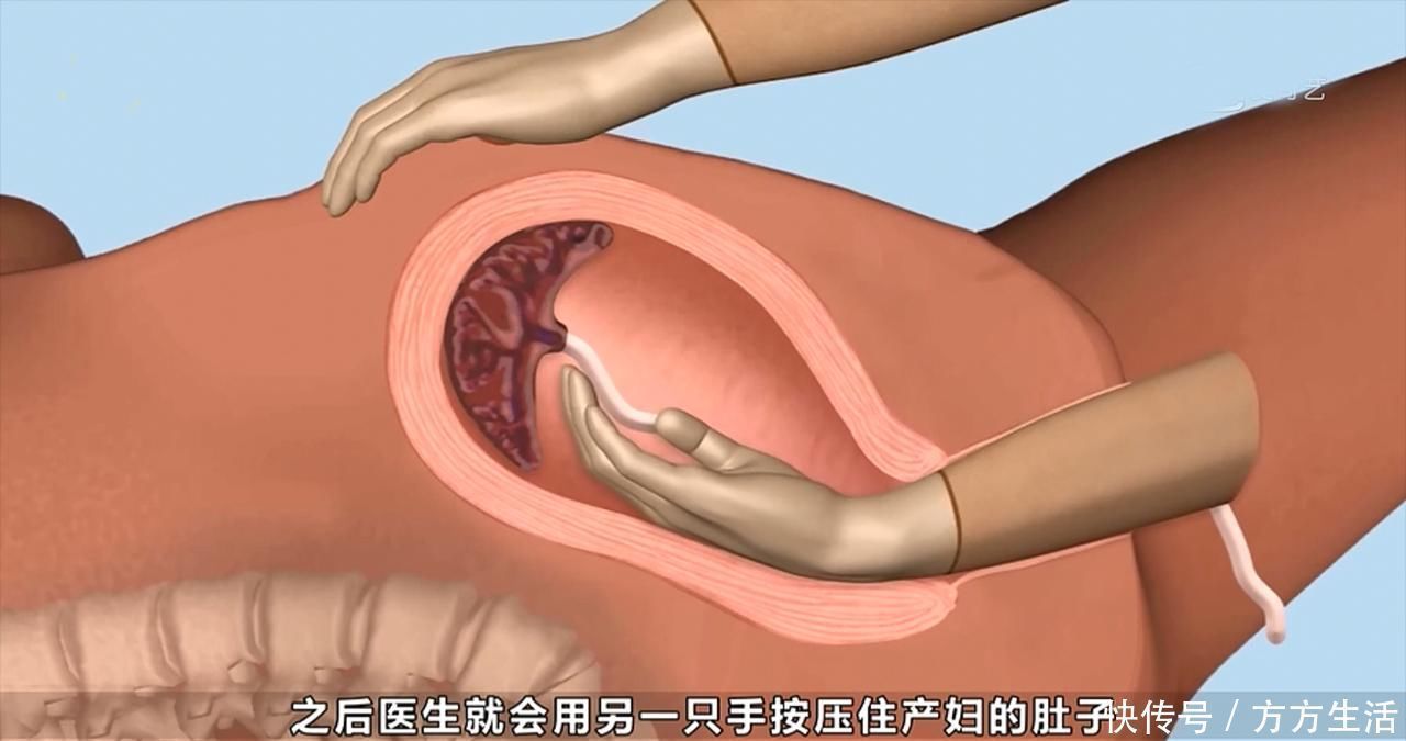 人工流产|5种产妇容易'手剥胎盘',第4种引发几率高,孕妈别忽视