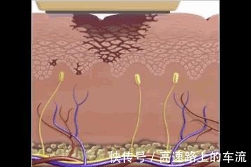 精准 美莱光子嫩肤和激光种类这么多,到底怎么选