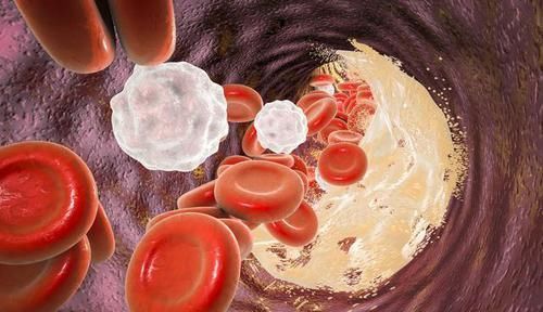 抗凝治疗|打通血管血栓的绝密配方,一个月内阻塞血管全部疏通?
