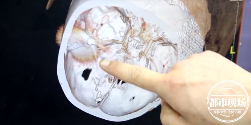 眉心|可怕！男子干活时，1个钉子突然射中眉心进入大脑