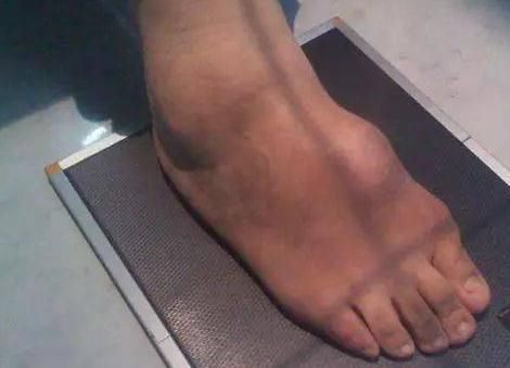 高脂血症|人为什么会得痛风?医生:想要成功预防痛风,做好这3点很重要