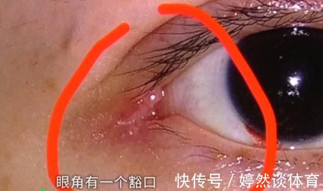 王女士|姑娘做“开眼角”，术后却感觉眼睛不对劲？医生：确实少缝了一针