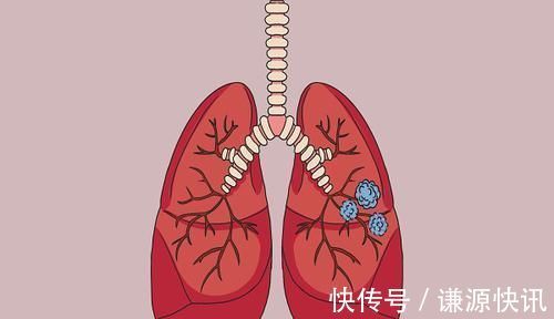 肺结节|磨玻璃肺结节随访观察,会有癌变的可能吗?