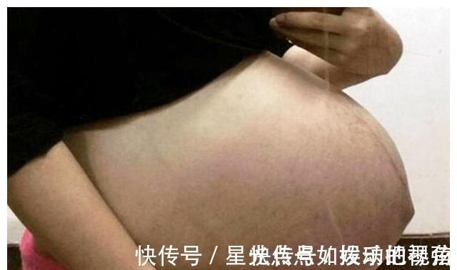 孕妇|女人如果多次剖腹产,肚子会变成什么样?看完觉得“头皮发麻”