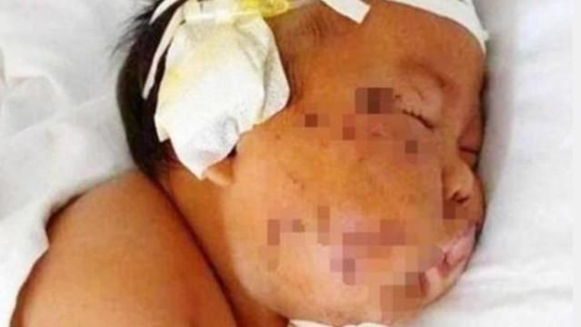 妈妈|4年了,哪个因喝奶太用劲,被妈妈用剪子戳脸的男宝宝现况怎样