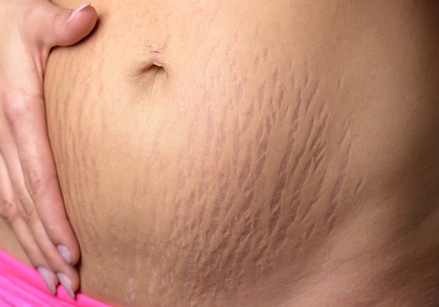 小丽|怀孕后,为啥有人会长妊娠纹,有人却不会长和这四个因素有关