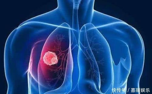 隐痛感|肺癌到来之前,身体也是有蛛丝马迹的,注意这4个身体表现