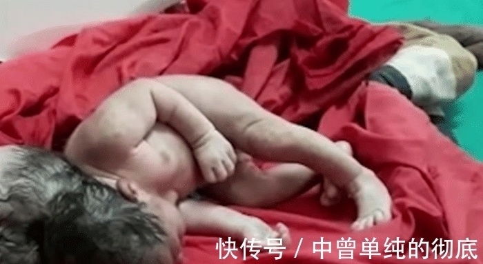 手术切除|奇闻:印度女子产下三头婴儿!怀孕期间并无异常,医生:外星人