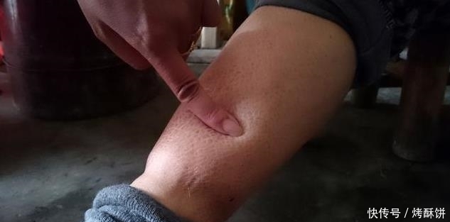 保护|被痛风肾缠上,常常有4个标志,做对2件事,降尿酸保护肾脏