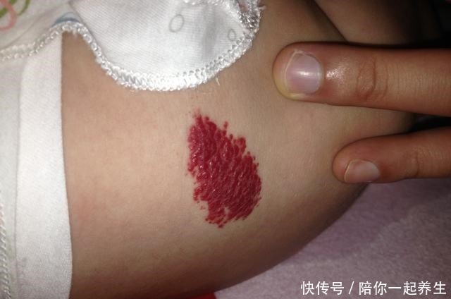 新生儿手臂生出“草莓斑”,宝妈以为碰了,医生检查后说要手术!