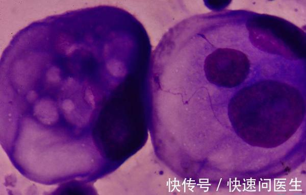 医生|原位癌是癌症吗?浸润癌、原发癌有什么不一样?医生的答案很清楚