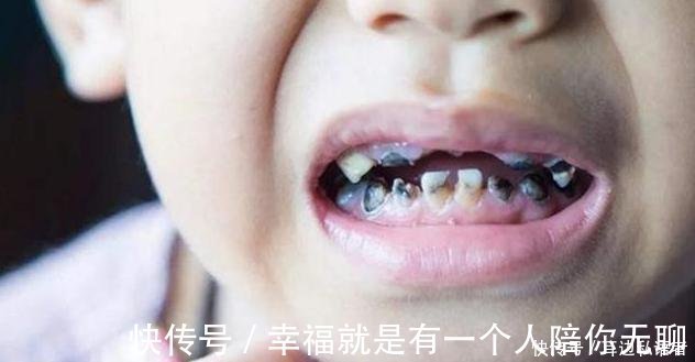牙齿|3岁儿子满口“小黑牙”,罪魁祸首不是糖果,而是父母的无知