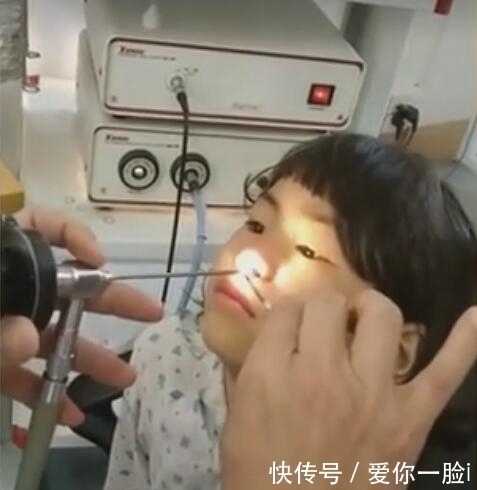 奇闻医生从小女孩鼻子里取出一条活虫子，女孩看见后一脸淡定