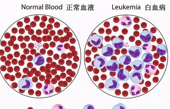 孩子|为什么越来越多孩子得白血病?医生:孩子有这5大异常,尽早就医