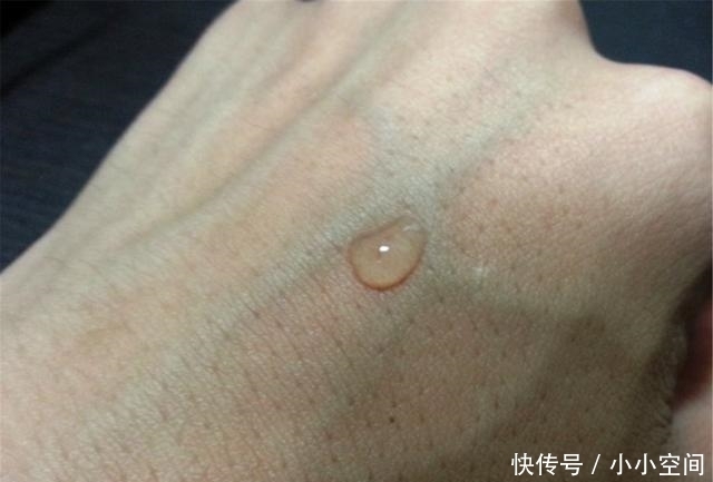  肝脏|肝不好的人，手上可能有这3个表现，记住3个动作，肝慢慢变好