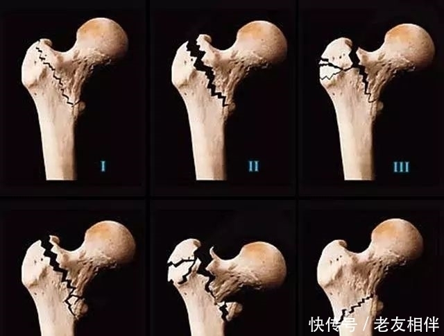 要命|髋关节疼起来真要命,到底为什么这么痛?要怎么治疗?