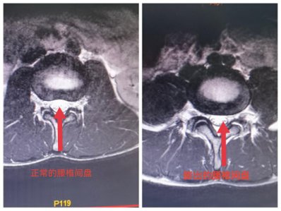 腰椎间盘|18岁高三男生，患上中老年常见病！因忽略了这件事